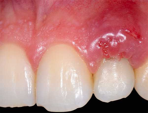 La photo montre une inflammation dans la zone de l'implant de la dent de la mâchoire supérieure - malheureusement, des complications après l'implantation se produisent parfois encore.