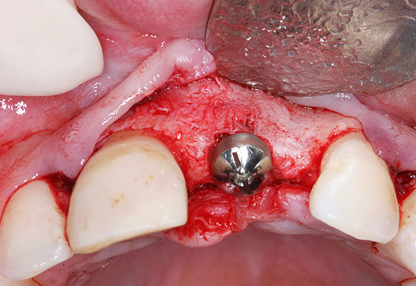 Des problèmes peuvent survenir à la fois pendant l'opération et après l'installation apparemment réussie de l'implant.