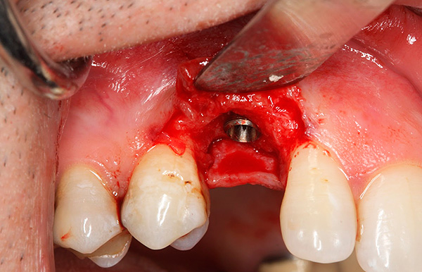 L'opération d'implantation dentaire est généralement assez traumatisante, par conséquent, les saignements ne peuvent généralement pas être supprimés.