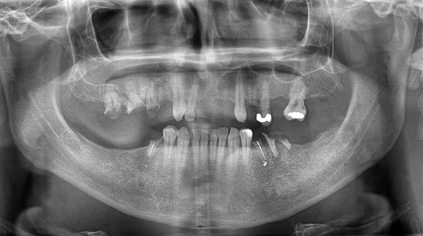 Cette image panoramique montre clairement que la distance entre les dents de la mâchoire supérieure et les sinus maxillaires est très faible.
