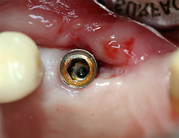 Corrosion des implants dentaires