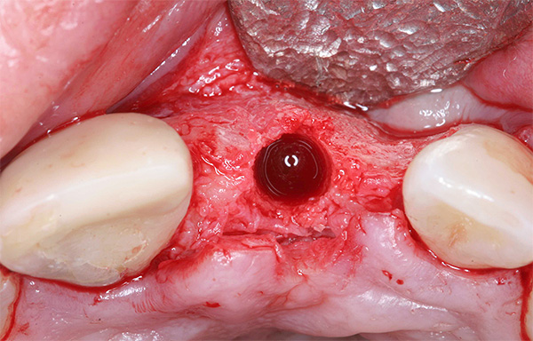 La photo montre un exemple d'implantation répétée après restauration du tissu osseux du processus alvéolaire.