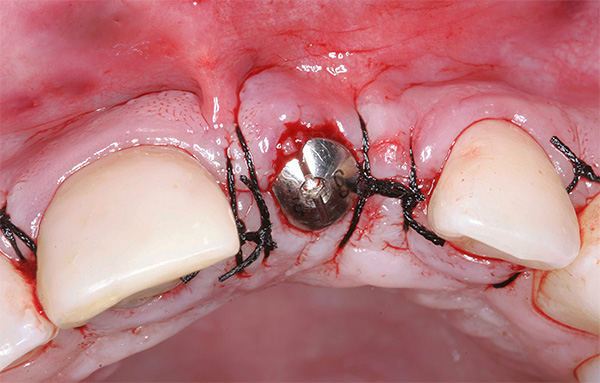Un bouchon est placé sur l'implant et la plaie est suturée.