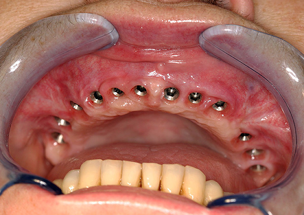 Une fois toutes les dents retirées, l'implantation peut être effectuée.
