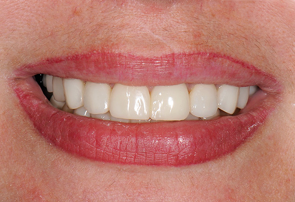 Le résultat du remplacement de tous les patients et des dents manquantes par des implants est un beau sourire uniforme et la capacité de mâcher normalement.