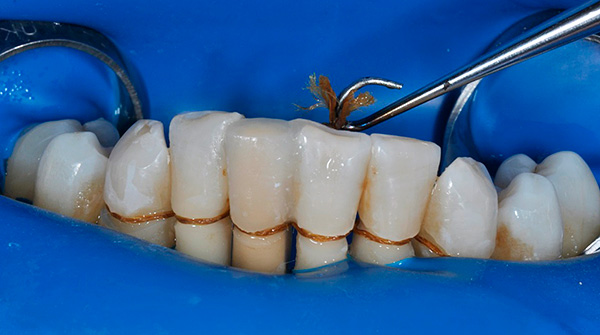 La photo montre un exemple d'attelles dentaires avec du fil dentaire spécial.