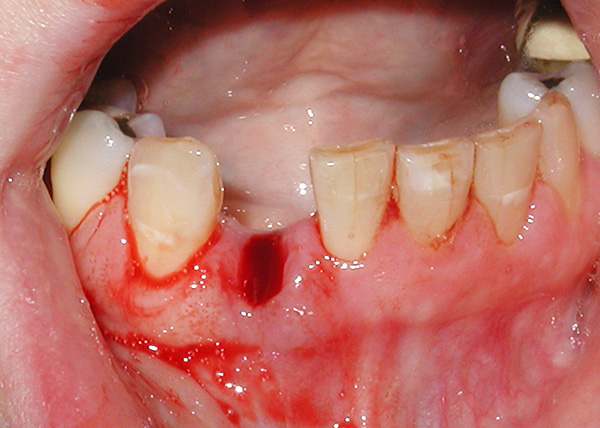 Avec la parodontite, il est très dangereux de laisser un espace vide dans la dentition sans attention ...