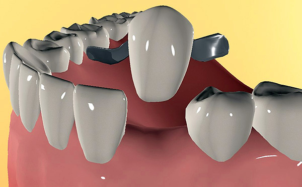 Même après un traitement contre la parodontite, il existe un risque que les dents deviennent mobiles et ne puissent plus tenir le bridge.