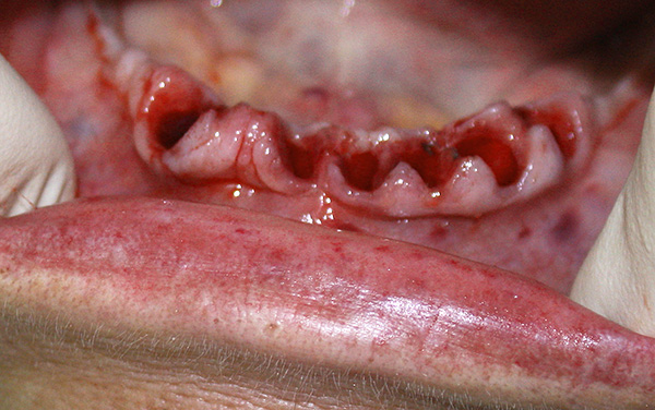 Dans les formes sévères de parodontite, plusieurs extractions dentaires sont souvent effectuées (puis les implants peuvent être remplacés à leur place).