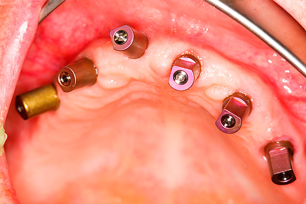 Souvent lors d'une maladie parodontale, une extraction dentaire complète est réalisée avec la pose simultanée d'implants.