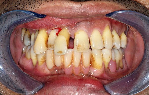 Selon l'état des dents, le plan de traitement individuel peut être différent ...
