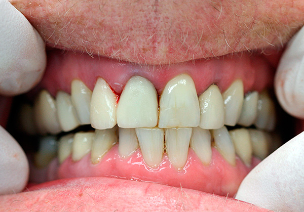 La photo montre un exemple de parodontite
