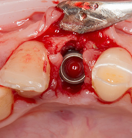 Avec la parodontite et la maladie parodontale, l'implantation en une étape peut être effectuée immédiatement après l'extraction dentaire.