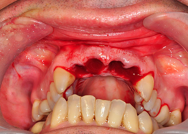 Par exemple, les implants basaux peuvent être placés immédiatement après l'extraction dentaire.