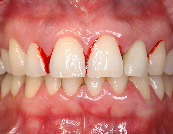 La gingivite est le précurseur de la parodontite - à ce stade, une augmentation des saignements des gencives peut déjà être observée ...