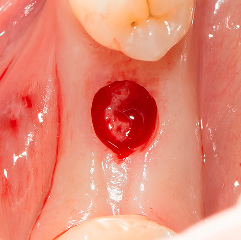 L'incision gingivale montrée sur la photographie a été réalisée à l'aide d'un mucotome circulaire.
