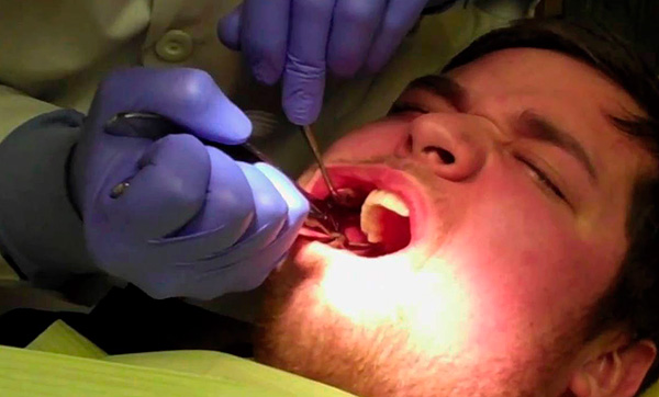 Si l'extraction dentaire ne se déroule pas très bien, le médecin peut décider d'abandonner l'installation de l'implant immédiatement.