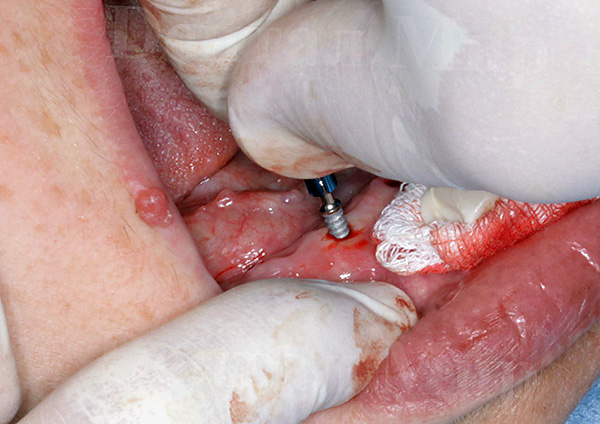 La photo montre un exemple de placement d'implant dans la mâchoire.
