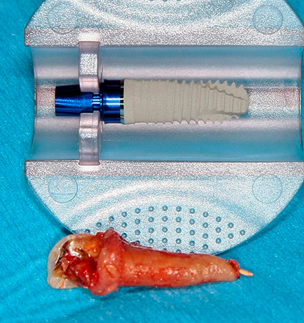 Pendant l'implantation express, un implant dentaire est inséré dans le trou immédiatement après la procédure d'extraction dentaire.