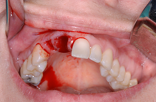 Un trou frais après l'extraction d'une dent est souvent tout à fait approprié pour y installer un implant.