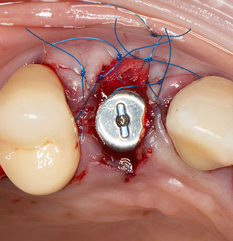 Étant donné le caractère invasif certain de la procédure, un gonflement et un saignement sont en effet possibles après la pose de l'implant.
