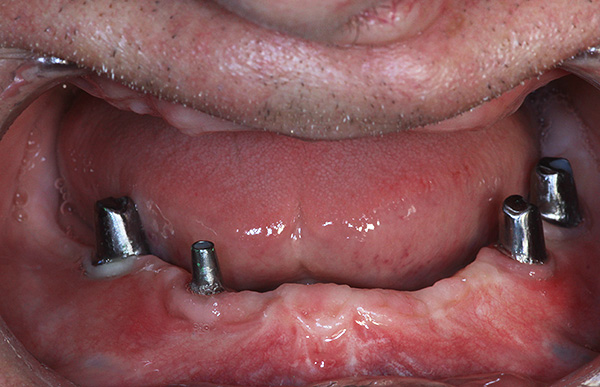 La photo montre un exemple de restauration de dents sur des implants dans la vieillesse ...