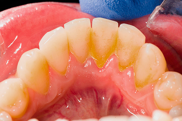 Une mauvaise hygiène buccale peut rapidement conduire à la formation de dépôts dentaires abondants (plaque et tartre).