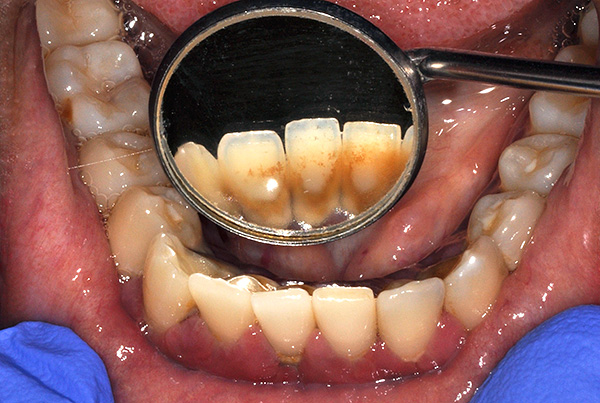 L'accumulation de plaque et de pierre à l'avenir peut entraîner une parodontite et une mobilité non seulement des dents indigènes, mais aussi des implants.