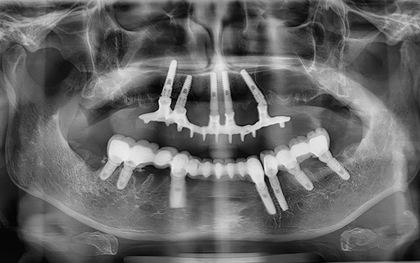 Dans de rares cas, un implant peut réellement endommager la paroi du sinus maxillaire.
