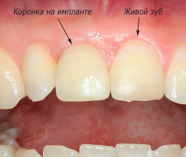 Sur cette photo, vous pouvez voir le résultat des prothèses de la dent avant sur l'implant XiVE.