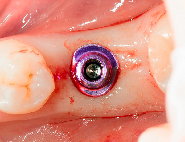 La photographie montre un implant XiVE placé dans la mâchoire.