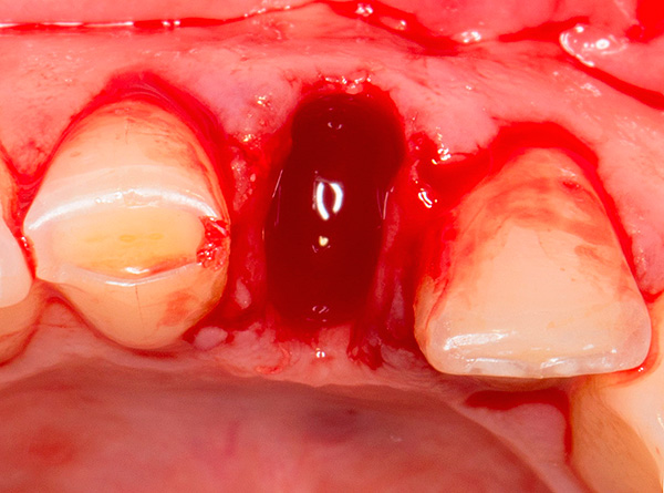 Dans certains cas, en utilisant des implants XiVE, l'implantation dite immédiate peut être réalisée en les plaçant dans le puits d'une dent qui vient d'être retirée.