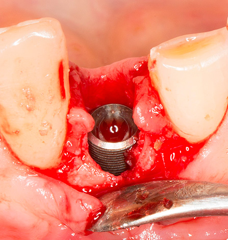L'implant est inséré dans le trou de la dent extraite ...