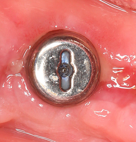 Un exemple d'implant bien implanté (un formateur de gencive est installé à l'extérieur).