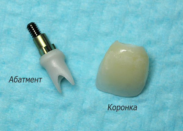 La partie secondaire et la couronne permanentes contribuent de manière significative au coût total des prothèses sur implants.