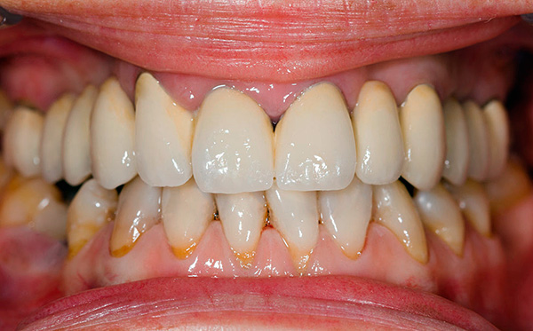 Si vous ne faites pas assez attention à l'hygiène buccale, la durée de vie des implants dentaires peut être très courte.