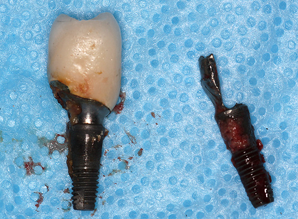 Malheureusement, les implants dentaires doivent parfois être retirés.