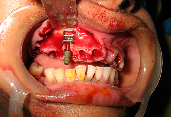 La photo montre un exemple d'installation d'un implant basal obsolète.