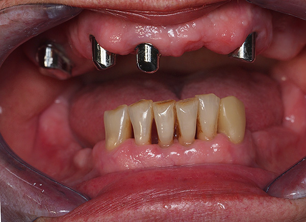 Situation clinique avant les prothèses - des couronnes métalliques sont installées sur les dents préservées de la mâchoire supérieure.