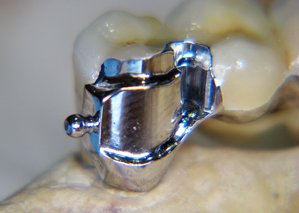 Une partie du verrou est située sur la couronne montée sur la dent.