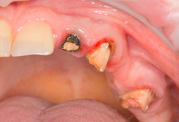 Avant la procédure de prothèse, certaines dents (ou leurs restes) peuvent devoir être retirées.