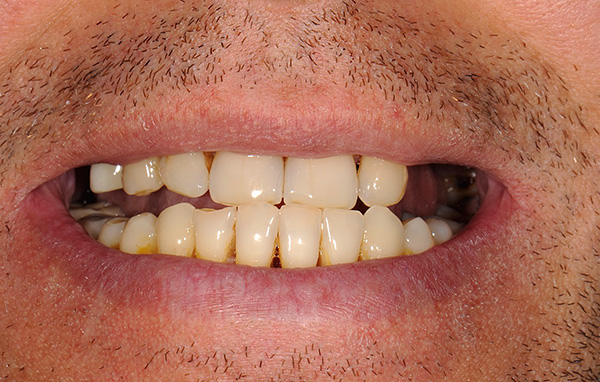 De multiples défauts de la dentition (en particulier les défauts d'extrémité) sont l'une des indications pour la mise en place d'une prothèse à fermoir.