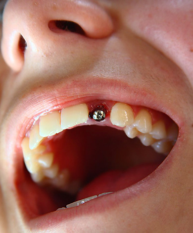 La photo montre un exemple d'installation d'un implant Alpha BIO dans une zone esthétiquement importante avec la perte d'une dent.