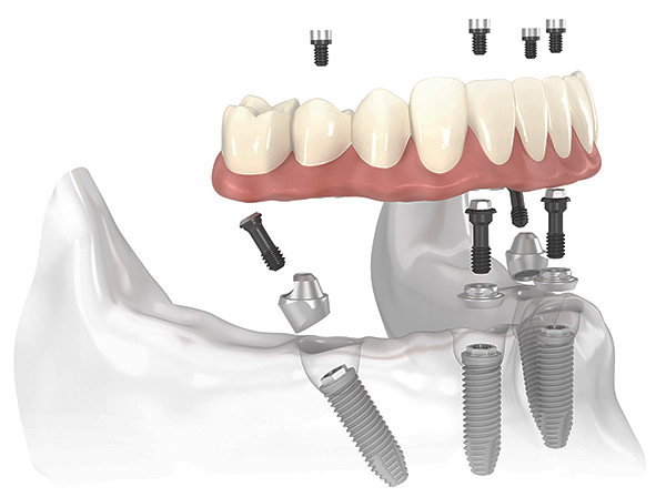 Schéma d'implantation de la prothèse dentaire tout-en-4.