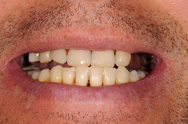 La photographie montre l’état des dents du patient avant le traitement avec des prothèses sur implants.