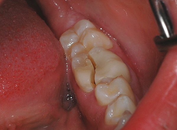 Un autre exemple d'une fracture très infructueuse d'une dent, alors qu'il est très probablement nécessaire de s'en séparer.