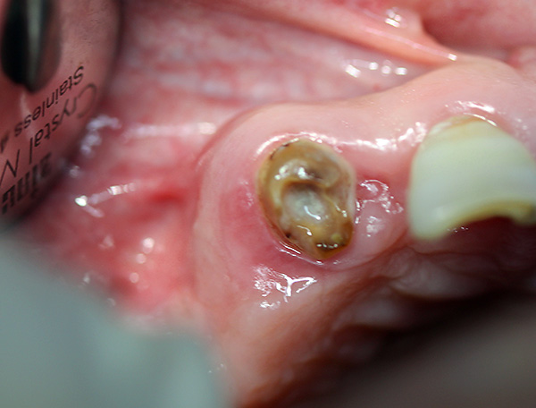 Il peut sembler que saisir une telle racine d'une dent endommagée avec une pince sera assez problématique, même si en pratique ce n'est souvent pas difficile.