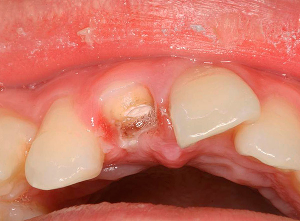 La racine d'une dent aussi gravement endommagée doit être enlevée.