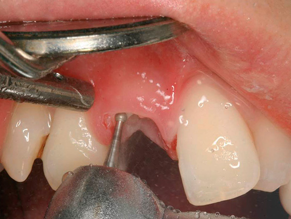 La racine de la dent est coupée par un foret en parties ...