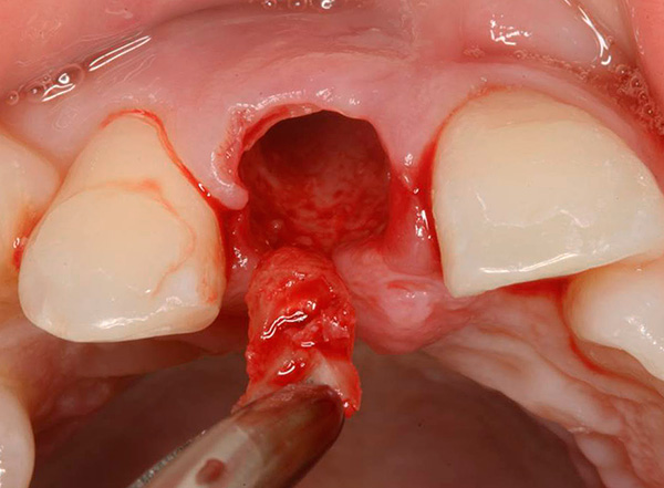En conséquence, la racine entière de la dent est retirée du trou.